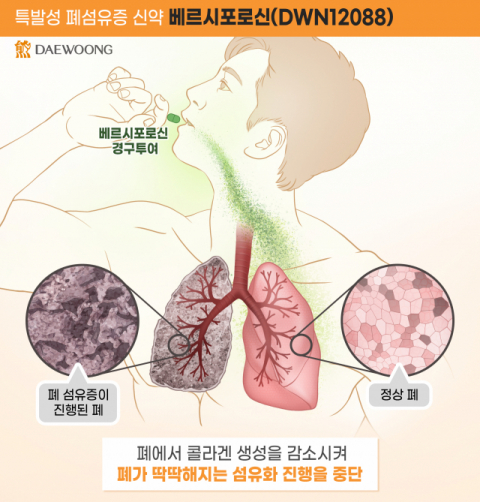 대웅제약, 특발성 폐섬유증 후보물질 &lsquo;베르시포로신&rsquo; EMA 희귀의약품 지정